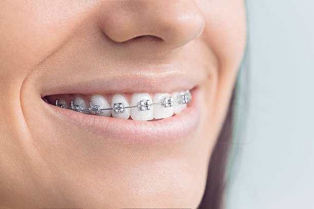 Dental Bonding in Plattsburgh, NY